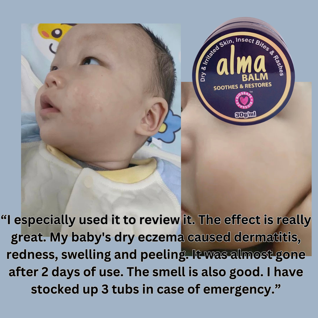 Eczema Relief Alma Balm 30g suits babies and up! For diaper rash, drool rash, eczema, insect bites